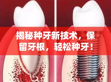 揭秘种牙新技术，保留牙根，轻松种牙！
